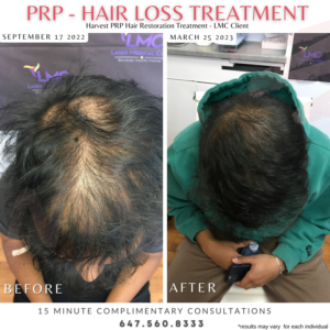 Prp Hair Loss Treatment Before And After