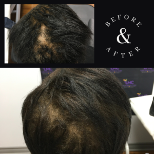 PRP Hair Loss Treatment Female 2023 Before And After