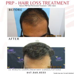 PRP Hair Loss Solution Male Before And After