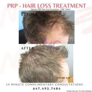 PRP Hair Restoration 2023 Male Before After