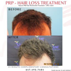 PRP Hair Treatment Male Client Before and After