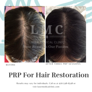 Prp Hair Restoration Therapy Female Before After