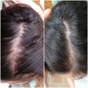 Prp Hair Restoration Therapy Female Before After Lmc