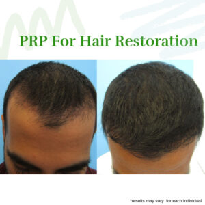 PRP Hair Restoration Therapy Male Before After
