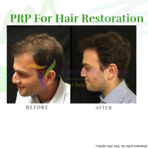 Prp Hair Restoration Therapy Male Before After Lmc Laser Medical Clinic