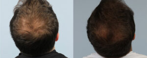 PRP Hair Treatment Male Before and After