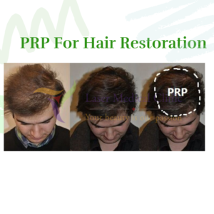 PRP Hair Restoration Therapy Male Before After Richmond Hill