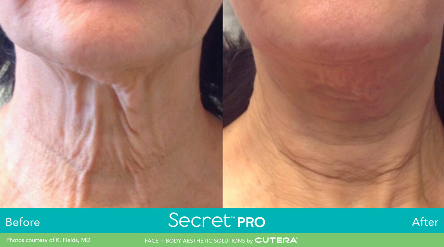 Secret Pro Rf Microneedling Before After Photo