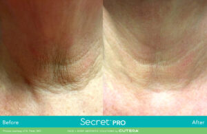 Secret Pro Rf Microneedling Before After Photo