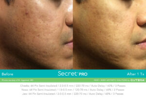 Secret Pro Rf Microneedling Before After Photo 4
