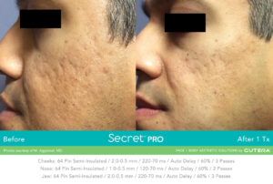 Secret Pro Rf Microneedling Before After Photo 5