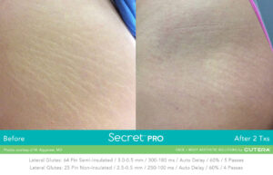 Secret Pro Rf Microneedling Before After Photo 7