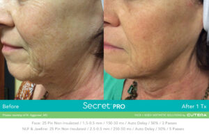Secret Pro Rf Microneedling Before After Photo 8