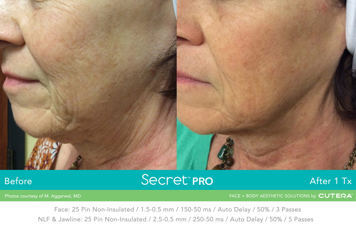 Secret Pro Rf Microneedling Before After Photo 8