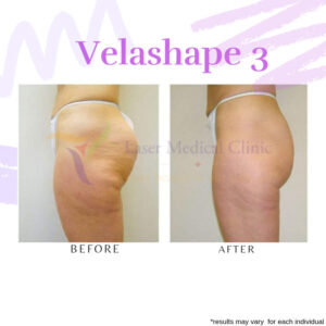Velaspape 3 Cellulite Reduction Before After