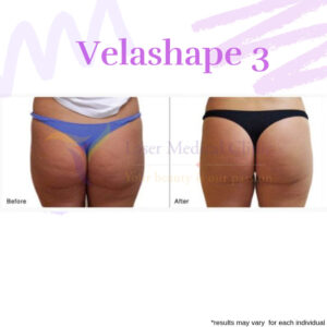 Velaspape 3 Cellulite Reduction Before After By Lmc