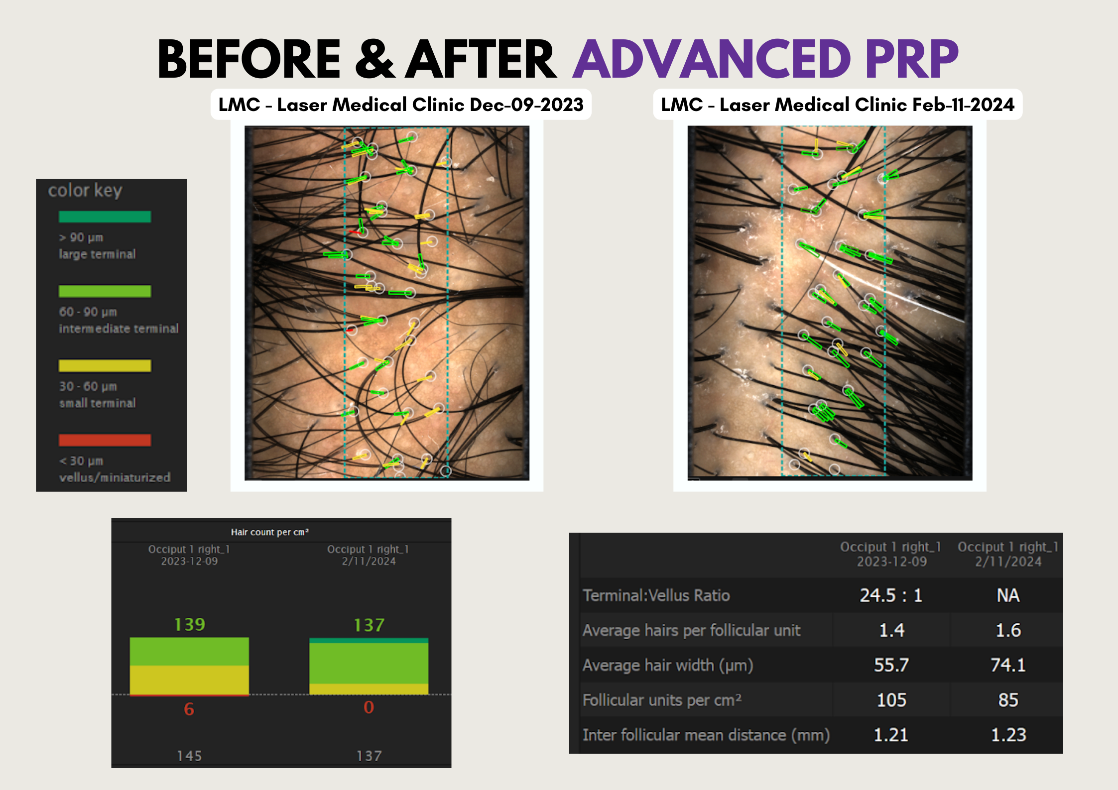 Before After Advanced Prp
