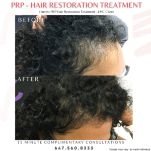 Female PRP Hair Restoration Client