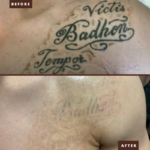 Enlighten 3 Tattoo Removal (1)