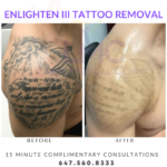 Enlighten 3 Tattoo Removal (1)