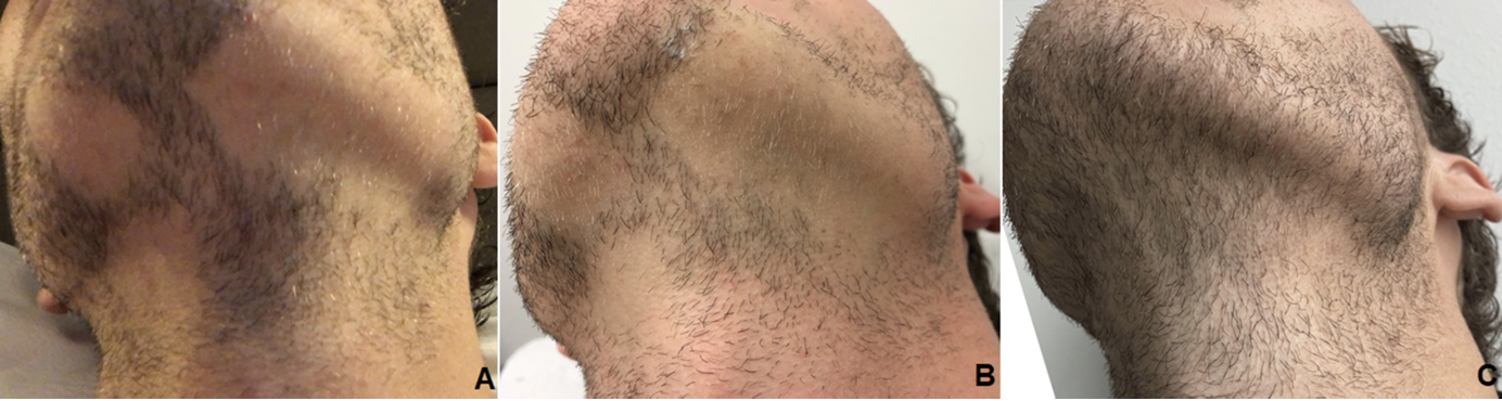 Prp Beard Hair Growth Restoration