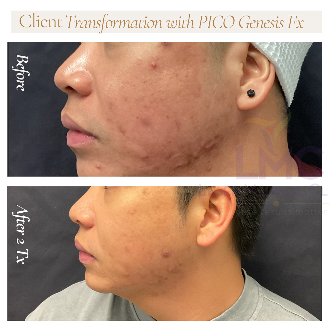 Pico Fx Male Before After Right