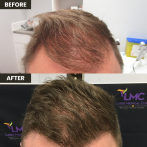 Lmc Before & After