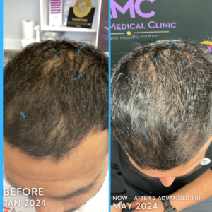 Bespoke PRP Hair Restoration Treatment Before and After: Male Top of Head