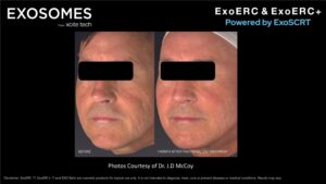 Benev Exosomes Male Before & After