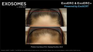 Benev Exosome Female Hairline Before & After