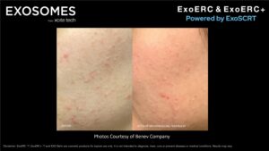 Benev Exosomes Face Before & After
