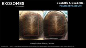 Benev Exosomes Hair Before & After
