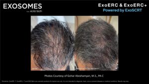 Benev Exosomes Hair Before & After
