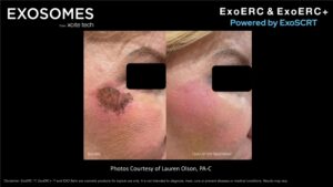 Benev Exosomes Female Before & After