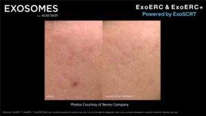 Benev Exosomes Before & After