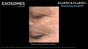 Benev Exosomes Eyes Before & After