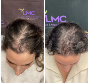 Advanced PRP Hair Restoration Treatment Before and After: Female Top of Head