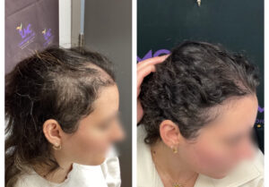 Bespoke PRP Hair Restoration Treatment Before and After: Female Side Profile