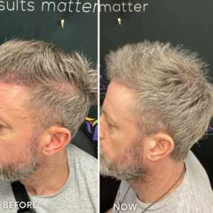 Top PRP Hair Restoration Treatment Before and After: Male Client Side Profile