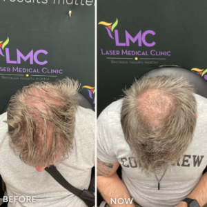 Advanced PRP Hair Restoration Treatment Before and After: Male Top of Head