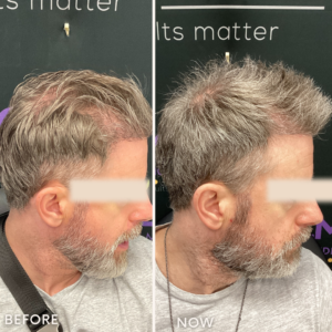 Bespoke PRP Hair Restoration Treatment: Male Side Profile