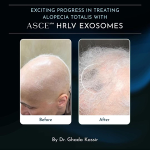 Hrlv Exosomes Before After Hair