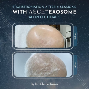Hrlv Exosomes Before After Scalp Hair