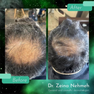 Hrlv Exosomes Hair Before After