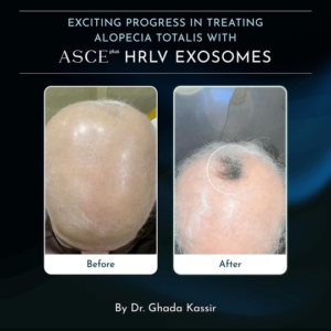 Hrlv Scalp Hair Exosomes Before After