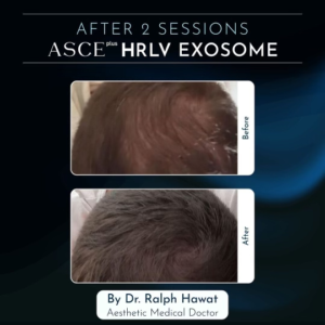 Scalp Hrlv Exosomes Before After