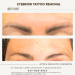 Before After Tattoo Removal Enlighten 3 Cutera