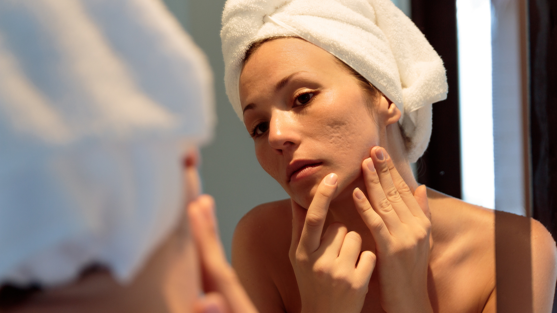 Acne Scar Treatment