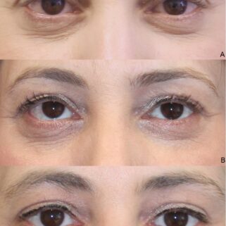 #1 Effective PRP/ PRF Under Eyes Treatment For Dark Circles