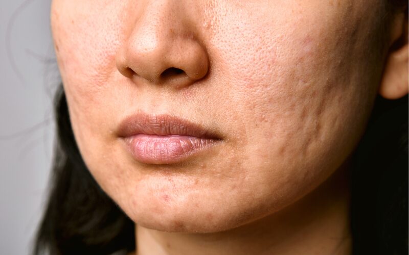 Treating Acne Scars with CO2 Laser Therapy